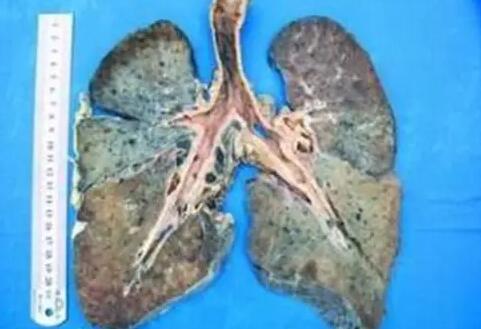 煙塵肺病——焊接手机看片网